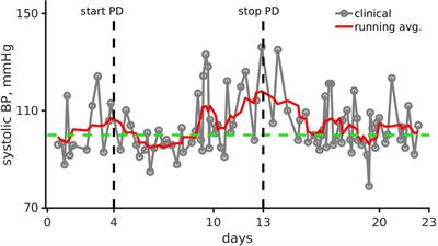 Arterial Hypertension and Unusual Ascending Aortic Dilatation in a Neonate With Acute Kidney Injury: Mechanistic Computer Modeling